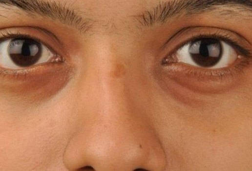 As olheiras podem ser causadas pele simples retencao de liquidos