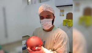 Medico mostra extracao de tumor gigante de quase 2 kg