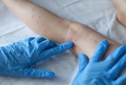 'Alô Saúde' é ampliado para atender dúvidas sobre Monkeypox