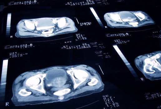 Brasileiro participa de pesquisa de tratamento de câncer de próstata