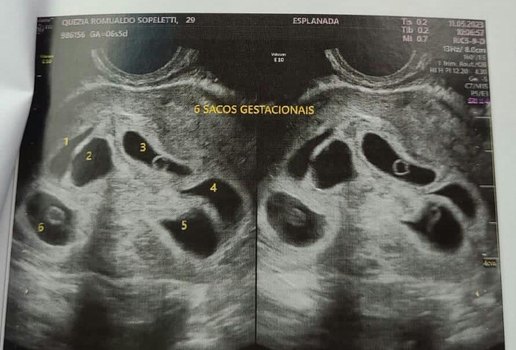 Mãe descobre gravidez de sêxtuplos durante ultrassom