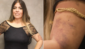 Bruna Surfistinha acusa ex-marido de agressão e mostra hematomas