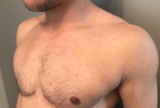 MASTECTOMIA ANATOMICA