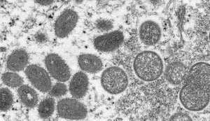 No Brasil, o primeiro caso de varíolas dos macacos foi confirmado em São Paulo.