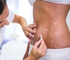 Surgeon drawing lines womans abdomen liposuction cellulite removal