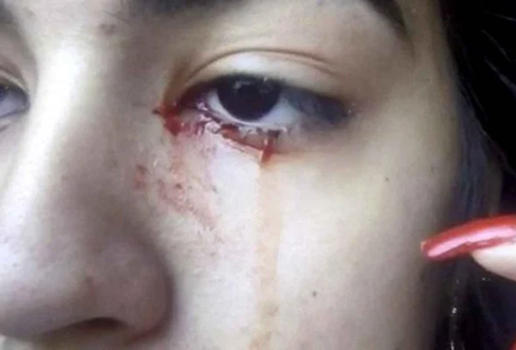 Adolescente chora sangue e intriga medicos no interior de Sao Paulo