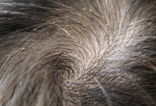 A pediculose caracteriza-se pela infestação de piolhos no couro cabeludo