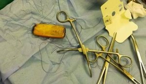 Homem faz cirurgia após passar seis meses com celular no estômago