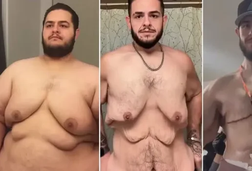Influencer perde 150 kg e retira 7 kg de excesso de pele