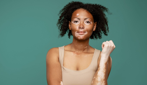 O vitiligo é uma doença autoimune que provoca a descoloração da pele (Imagem: Dean Drobot | Shutterstock)
