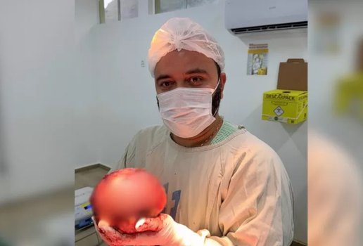 Medico mostra extracao de tumor gigante de quase 2 kg