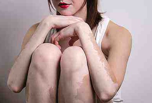 Vitiligo treatment