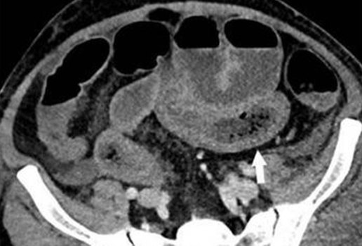 Coronavirus no intestino