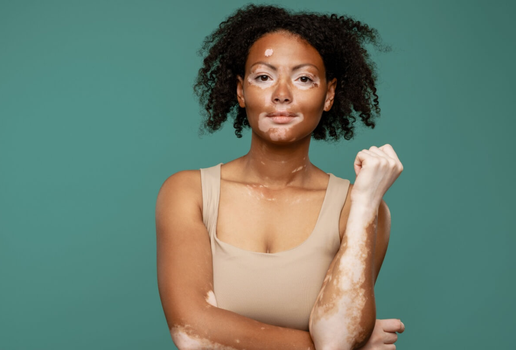 O vitiligo é uma doença autoimune que provoca a descoloração da pele (Imagem: Dean Drobot | Shutterstock)