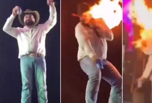 Sertanejo mostra como ficou seu rosto apos ser queimado em show