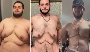 Influencer perde 150 kg e retira 7 kg de excesso de pele