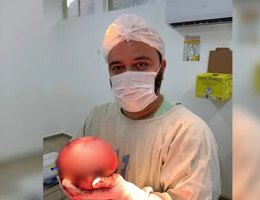 Medico mostra extracao de tumor gigante de quase 2 kg