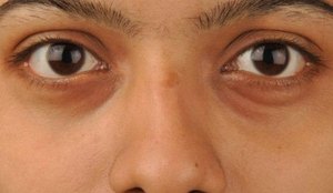 As olheiras podem ser causadas pele simples retencao de liquidos