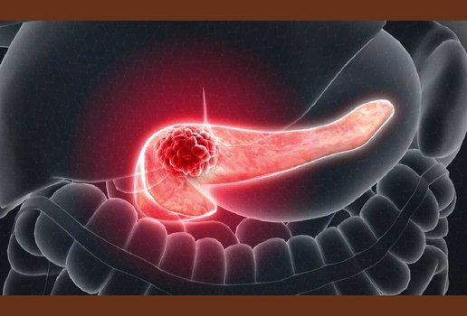 Vírus geneticamente modificado combate câncer do pâncreas