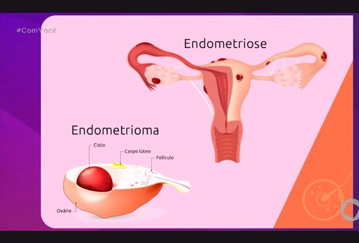 Endometriose tv tambau