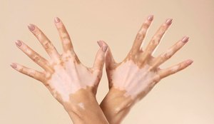 O vitiligo não é contagioso