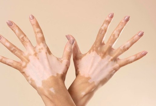 O vitiligo não é contagioso