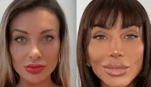 Cirurgia que altera cor do olho tem uso restrito para pessoas cegas